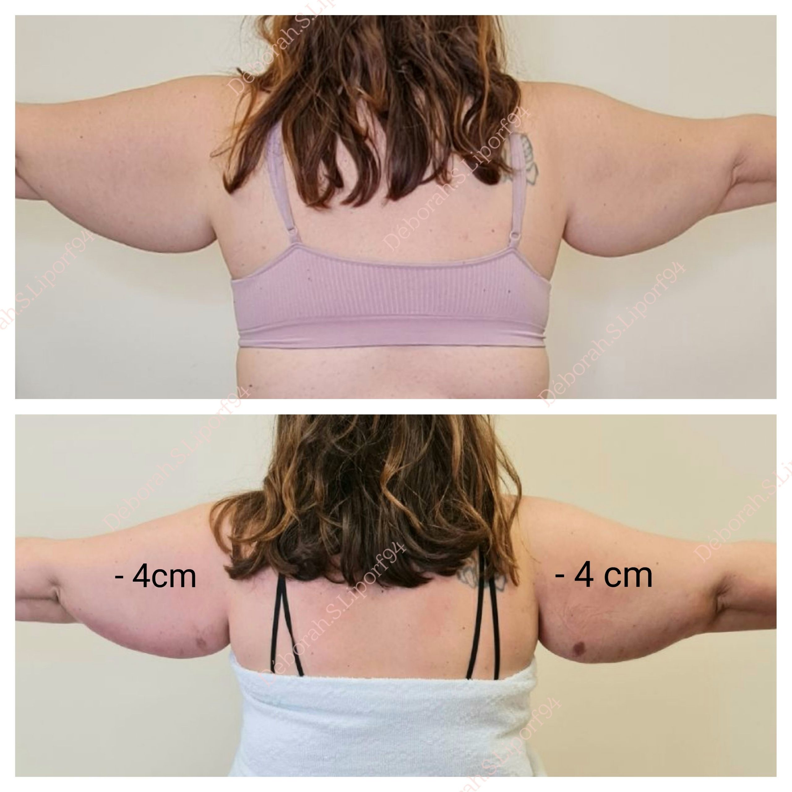 Resultat Avant / Après lipocavitation Radiofréquence corps